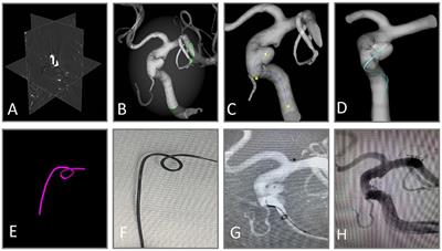 Virtual simulation with AneuShape™ software for microcatheter shaping in intracranial aneurysm coiling: a validation study